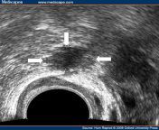 hrep583160 fig5.gif from indian vaginal ultrasound video