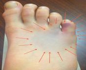 bruising suggestive of foot metatarsal fracture.jpg from thidoip feet