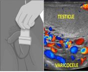 vericocele and scrotal doppler.jpg from varicocele