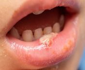 child having swollen lower lip winth infection pus causing mouth ulcers macro big canker sores s caused post 210807918.jpg from คลิปไฮไลต์บอลโลก 【winth net】 เว็บตรง100 itx