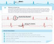 6275b691b1164c3adcd98f0e premature atrial contraction min.png from apccjs egk