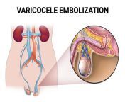 varicocele embolization.jpg from varicocele