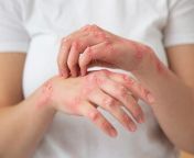 syphilis treatment in goa.jpg from hand skin goa