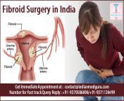 india offers the most advanced options for treating fibroids in the uterus.png from indian aunty uterus operation