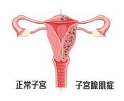 adenomyosis graphic.jpg from 子宫