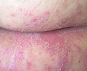 health yeast infection 162 canp ec7c1871fef741718c13a6ec3876c876.jpg from pusyeasty