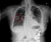 20170927 lung mass.jpg from rany x