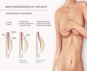 implantatlage dr luise berger brustvergroesserung.jpg from schlauchtitte