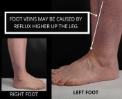 foot veins may be caused by reflux higher up the leg 3.jpg from 2016 feet veiny