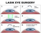 lasik eye surgery.jpg from ljsij erfye