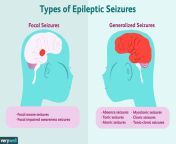 epilepsy overview 4155857 final edited dcaf959b3f214bc3b6b6e48302a5430a.png from sexihurs