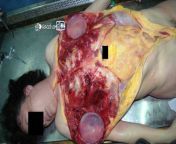 breast implants in a autopsy d75vs623ni.jpg from autopsy breastan