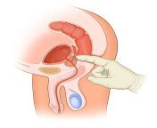 rectal exam of a normal male in cross royalty free illustration 1700497028.jpg from anal mal