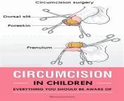 e365ecb7aff15a844d32bfc665cd910d circumcision care midwifery.jpg from circumsize