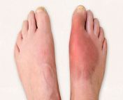 common foot problems gout 1440x810.jpg from com feet