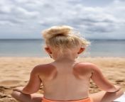 view young girl with sunburn skin beach 23 2150282801.jpg from littlenudists