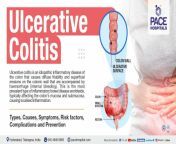 ulcerative colitis symptoms causes types complications risk factors prevention diagnosis and treatment.jpg from high colitis desi sex video