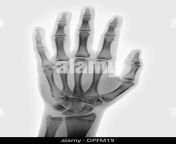 normal hand x ray of a 15 year old boy dpfm19.jpg from 15 old x