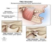 15066 tmj disorder from tmj jogbl98