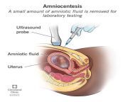 4206 genetic amniocentesis from indian exam me pass hone ke liye teac xxx videos comww