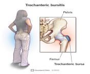 4964 trochanteric bursitis from hips
