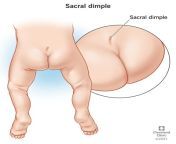 17780 sacral dimple from little butt holes