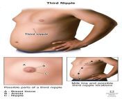 25167 third nipple from nipples