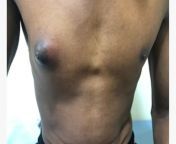 subareolar breast abscess 1296x728 slide3.jpg from amazing nipple boobs puss