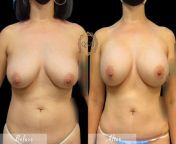 breast augmentation1 2 1030x748.jpg from natural tit