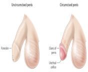 uncircumcised circumcised penises m.jpg from penis circum