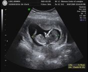 x1080 from indian vaginal ultrasound video