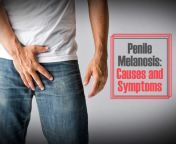 dark genital area could be sign of penile melanosis causes symptoms risk factors and more jpeg from black colour small penies
