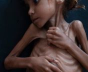 أمل حسين ، فتاة يمنية تبلغ من العمر 7 سنوات ، تعاني من سوء تغذية حاد حاد.jpg from ندى شرموطة يمنية