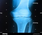 x ray of a 15 years old girl knee b5328f.jpg from 15 old x
