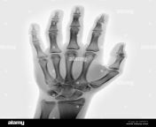 normal hand x ray of a 15 year old boy dpfm19.jpg from 15 old x