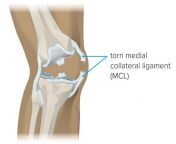 medial collateral ligament mcl tear picture.jpg from mcl33gobvgi