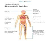 effects on the body of rheumatoid arthritis infographic.jpg from body of