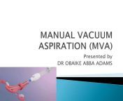 mvapresentation 180511040443 thumbnail jpgwidth640height640fitbounds from breast massage manual vacuum aspiration breast enlargement device breast pump breast cup sex toy for jpg q50 jpg