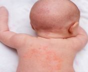 how to get rid of heat rash in babies.jpg from heat rash