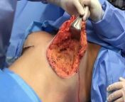 hash1 from autopsy breastan