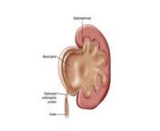 ureteropelvic junction obstruction what is it symptoms diagnosis and treatment.jpg from upj