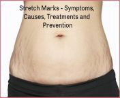 stretch marks article.jpg from stretch marks on the abdomen