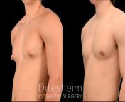male chest gynecomastia teen puffy nipple jh obl.jpg from puffy nipples teens