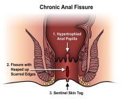 anal fissure.jpg from anal